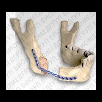 Костная пластина для остеотомии для нижней челюсти CARCITEK