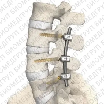 Система остеосинтеза для грудопоясничной зоны DIPLOMAT