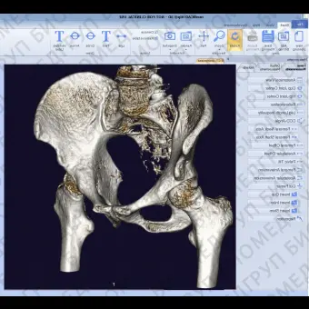 Программное обеспечение TDM mediCAD 3D Hip