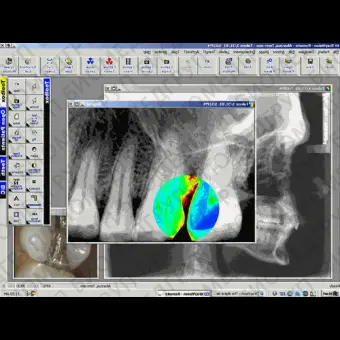 Программное обеспечение для обработки снимков зубов XrayVision