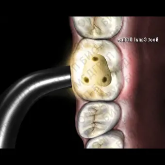 Детектор кариеса диафаноскопией Microlux