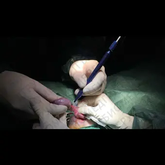 Лазер для ветеринарной хирургии LUMIX SURGERY DUAL VETERINARY