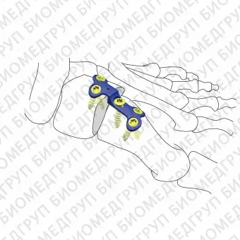 Костная пластина для артродеза ступня HJFoot VALOC 03