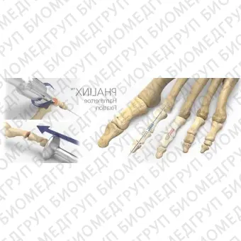 Компрессирующий винт для кости артродез межфалангового сустава ноги PHALINX